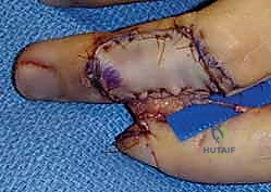 صورة طبية: إعادة بناء طرف الإصبع: استعادة الحساسية والوظيفة مع الأستاذ الدكتور محمد هطيف في صنعاء