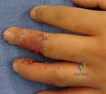 صورة طبية: إعادة بناء طرف الإصبع: استعادة الحساسية والوظيفة مع الأستاذ الدكتور محمد هطيف في صنعاء