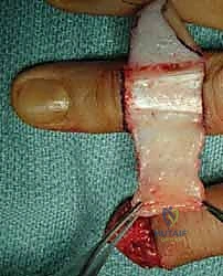 صورة طبية: إعادة بناء طرف الإصبع: استعادة الحساسية والوظيفة مع الأستاذ الدكتور محمد هطيف في صنعاء