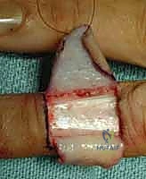 صورة توضيحية لـ إعادة بناء طرف الإصبع: استعادة الحساسية والوظيفة مع الأستاذ الدكتور محمد هطيف في صنعاء