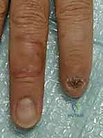 صورة طبية: إعادة بناء طرف الإصبع: استعادة الحساسية والوظيفة مع الأستاذ الدكتور محمد هطيف في صنعاء