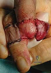 صورة طبية: إعادة بناء طرف الإصبع: استعادة الحساسية والوظيفة مع الأستاذ الدكتور محمد هطيف في صنعاء