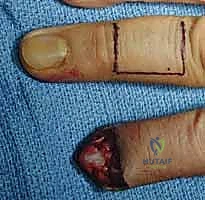 صورة طبية: إعادة بناء طرف الإصبع: استعادة الحساسية والوظيفة مع الأستاذ الدكتور محمد هطيف في صنعاء