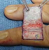 صورة طبية: إعادة بناء طرف الإصبع: استعادة الحساسية والوظيفة مع الأستاذ الدكتور محمد هطيف في صنعاء