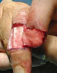 صورة طبية: إعادة بناء طرف الإصبع: استعادة الحساسية والوظيفة مع الأستاذ الدكتور محمد هطيف في صنعاء