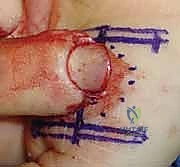 التعامل مع إصابات الأبواب للأطفال