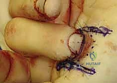 صورة طبية: إعادة بناء طرف الإصبع: استعادة الحساسية والوظيفة مع الأستاذ الدكتور محمد هطيف في صنعاء