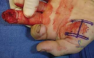 صورة طبية: إعادة بناء طرف الإصبع: استعادة الحساسية والوظيفة مع الأستاذ الدكتور محمد هطيف في صنعاء