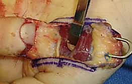 صورة طبية: إعادة بناء طرف الإصبع: استعادة الحساسية والوظيفة مع الأستاذ الدكتور محمد هطيف في صنعاء