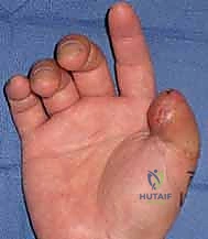 صورة طبية: إعادة بناء طرف الإصبع: استعادة الحساسية والوظيفة مع الأستاذ الدكتور محمد هطيف في صنعاء