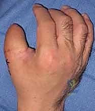 صورة طبية: إعادة بناء طرف الإصبع: استعادة الحساسية والوظيفة مع الأستاذ الدكتور محمد هطيف في صنعاء