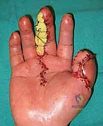 صورة طبية: إعادة بناء طرف الإصبع: استعادة الحساسية والوظيفة مع الأستاذ الدكتور محمد هطيف في صنعاء