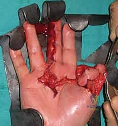 صورة طبية: إعادة بناء طرف الإصبع: استعادة الحساسية والوظيفة مع الأستاذ الدكتور محمد هطيف في صنعاء