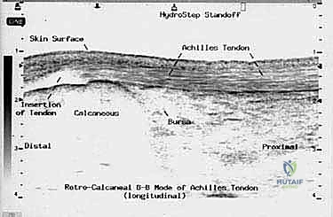 إصلاح وتر أخيل المفتوح بتقنية "صندوق الهدايا": دليل شامل من الأستاذ الدكتور محمد هطيف
