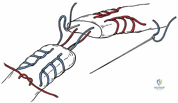 صورة توضيحية لـ إصلاح وتر أخيل المفتوح بتقنية "صندوق الهدايا": دليل شامل من الأستاذ الدكتور محمد هطيف