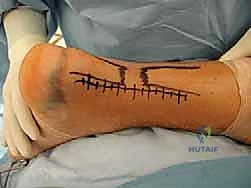 صورة توضيحية لـ إصلاح وتر أخيل المفتوح بتقنية "صندوق الهدايا": دليل شامل من الأستاذ الدكتور محمد هطيف