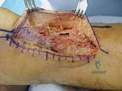 صورة طبية: إصلاح وتر أخيل المفتوح بتقنية "صندوق الهدايا": دليل شامل من الأستاذ الدكتور محمد هطيف