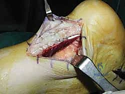 صورة طبية: إصلاح وتر أخيل المفتوح بتقنية "صندوق الهدايا": دليل شامل من الأستاذ الدكتور محمد هطيف