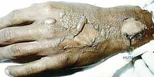 Masterclass in Distal Upper Extremity Skin Grafting & Substitutes: An Intraoperative Guide