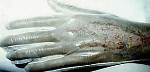 صورة توضيحية لـ ترقيع الجلد في اليد والمعصم: دليل شامل للمرضى مع الأستاذ الدكتور محمد هطيف