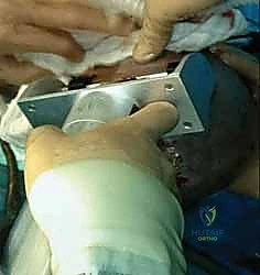 أسباب تستدعي ترقيع الجلد