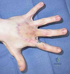 صورة توضيحية لـ ترقيع الجلد في اليد والمعصم: دليل شامل للمرضى مع الأستاذ الدكتور محمد هطيف