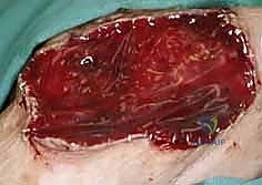 ترقيع الجلد في اليد والمعصم: دليل شامل للمرضى مع الأستاذ الدكتور محمد هطيف