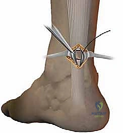 تشخيص تمزق وتر أخيل واختبار طومسون