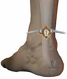 استخدام أداة Achillon في الجراحة المحدودة