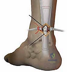 صورة طبية: إصلاح تمزق وتر أخيل المحدود بالمنظار: دليل شامل من الأستاذ الدكتور محمد هطيف في صنعاء