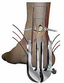 صورة توضيحية لـ إصلاح تمزق وتر أخيل المحدود بالمنظار: دليل شامل من الأستاذ الدكتور محمد هطيف في صنعاء