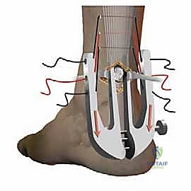 صورة توضيحية لـ إصلاح تمزق وتر أخيل المحدود بالمنظار: دليل شامل من الأستاذ الدكتور محمد هطيف في صنعاء