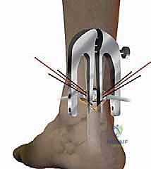 صورة توضيحية لـ إصلاح تمزق وتر أخيل المحدود بالمنظار: دليل شامل من الأستاذ الدكتور محمد هطيف في صنعاء