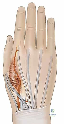 صورة توضيحية لـ ترميم الأطراف العلوية المتقدم: تقنيات السدائل الجراحية لإعادة الوظيفة والجمال مع الأستاذ الدكتور محمد هطيف