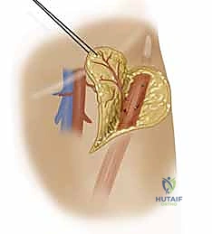 إغلاق الجرح بشكل تجميلي