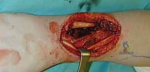 ترميم الأطراف العلوية المتقدم مع الأستاذ الدكتور محمد هطيف