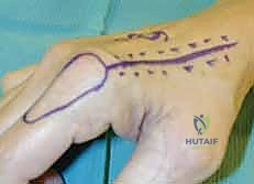 المفاغرة الوعائية الدقيقة