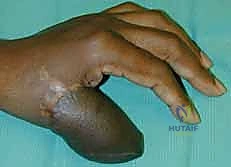 صورة طبية: ترميم الأطراف العلوية المتقدم: تقنيات السدائل الجراحية لإعادة الوظيفة والجمال مع الأستاذ الدكتور محمد هطيف