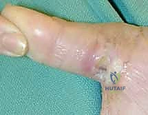 ترميم الأطراف العلوية المتقدم: تقنيات السدائل الجراحية لإعادة الوظيفة والجمال مع الأستاذ الدكتور محمد هطيف