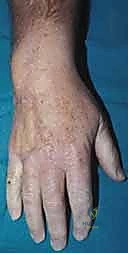 تثبيت السديلة في مكانها الجديد