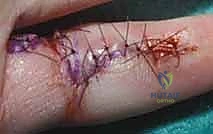 Illustration of posterior interosseous artery - Dr. Mohammed Hutaif