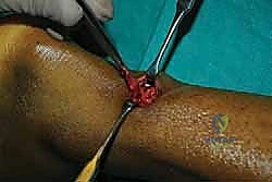 صورة توضيحية لـ إصلاح وتر أخيل بالحد الأدنى للتدخل الجراحي: دليل شامل للمرضى