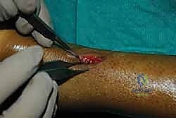 صورة توضيحية لـ إصلاح وتر أخيل بالحد الأدنى للتدخل الجراحي: دليل شامل للمرضى