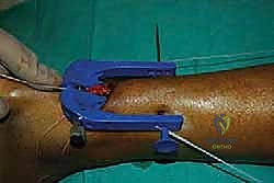 تحديد منطقة التمزق الوعائية الفقيرة