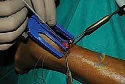 التشريح الدقيق لوتر أخيل