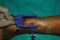 فحص أسباب تمزق الوتر