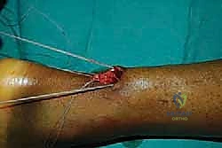 تخطيط المعالم الجراحية على الجلد