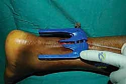 عمل الشق الجراحي الصغير