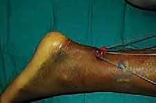 إحكام الخيوط في الجزء العلوي