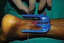 إدخال جهاز التوجيه الجراحي